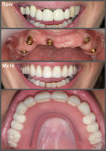 Επένθετη ολική οδοντοστοιχία άνω γνάθου σε πέντε εμφυτεύματα